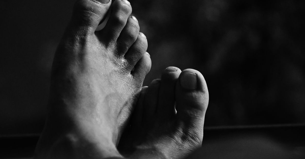 Hammer Toe Pain Relief: Conservative Care & Massage