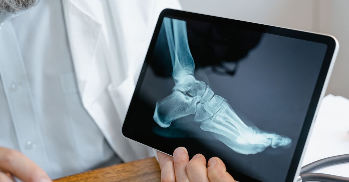Posterior Tibial Tendonitis: Symptoms & Early Treatment